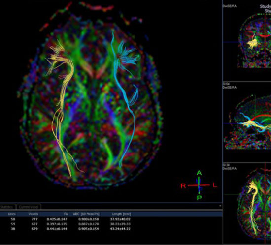 cerebro